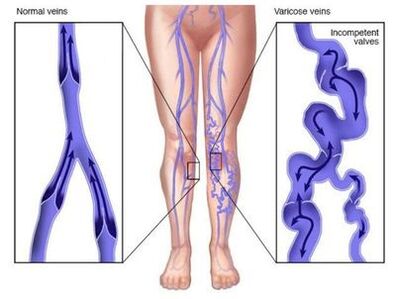 Neoveris apsaugo nuo venų deformacijos